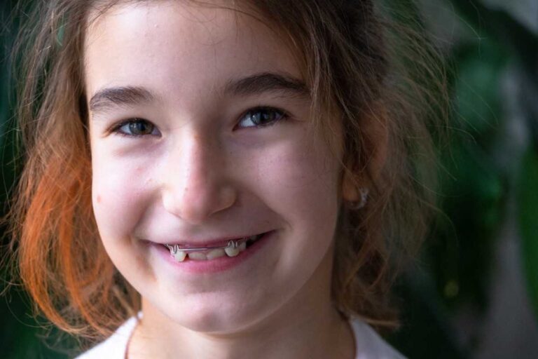 Palatal Expanders for Kids: Typical Duration and Care