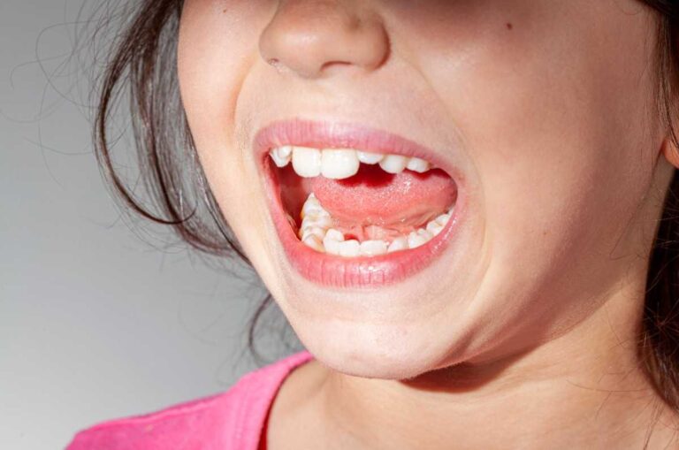 Understanding the Different Types of Phase 1 Orthodontics for Kids
