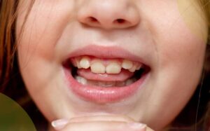 Traditional vs. IPE Palatal Expanders: What Parents Need to Know