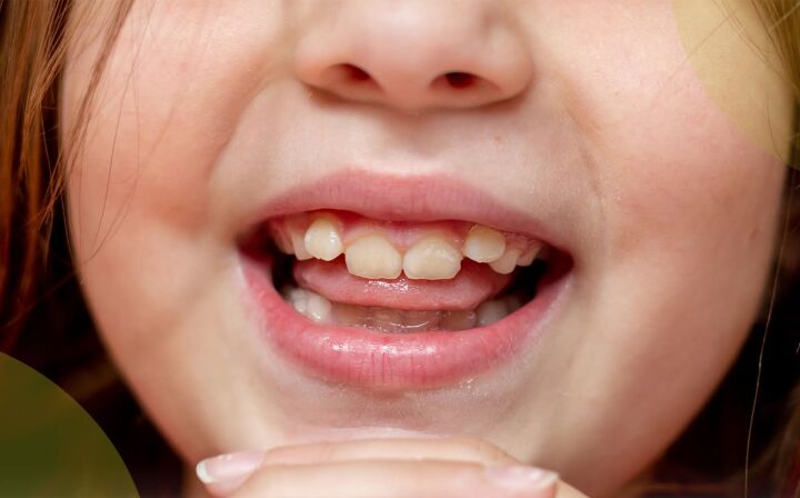 Traditional vs. IPE Palatal Expanders: What Parents Need to Know