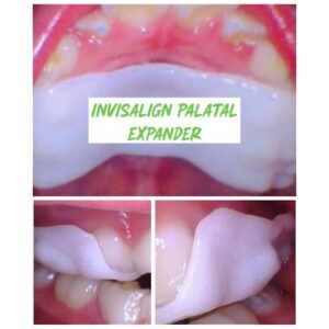 Signs Your Child May Need a Palatal Expander