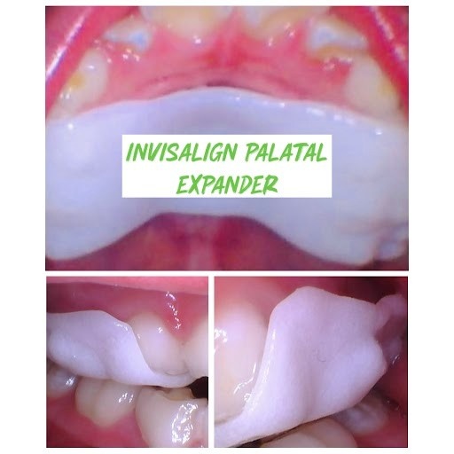 Signs Your Child May Need a Palatal Expander