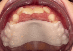 How Palatal Expanders Help Correct Crowding and Bite Issues Early