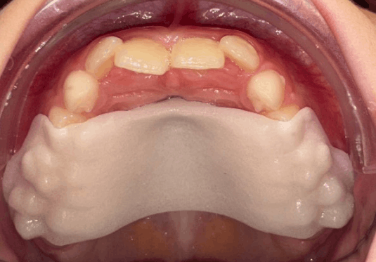 How Palatal Expanders Help Correct Crowding and Bite Issues Early