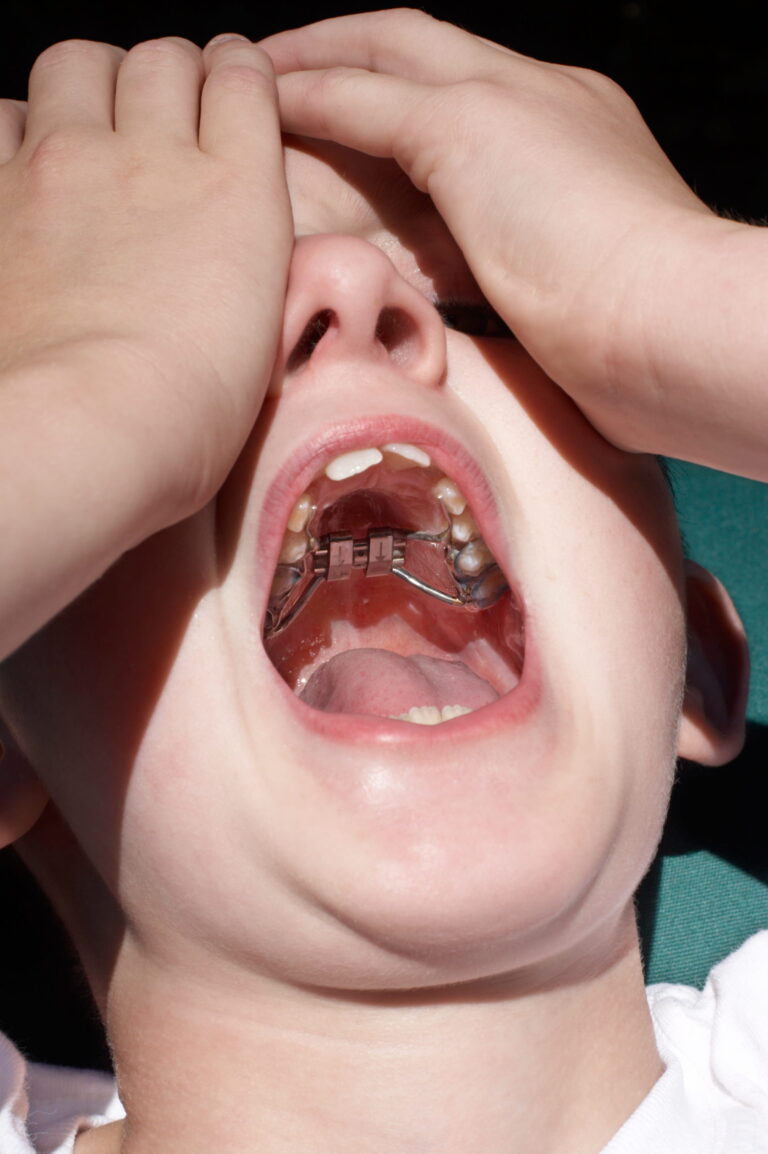 Narrow Palate or Crowded Smile? When Palatal Expansion May Help